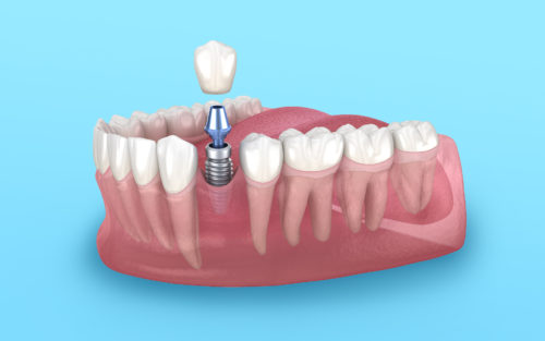 Dentatec Implantat